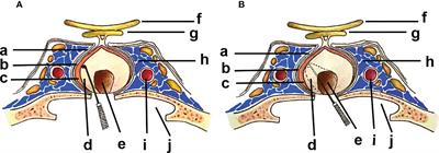 Pseudocapsule and pseudocapsule-based extracapsular resection in pituitary neuroendocrine tumors